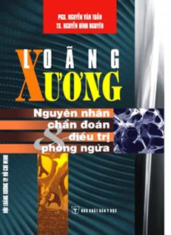 Loãng Xương – Nguyên Nhân, Chẩn Đoán , Điều Trị