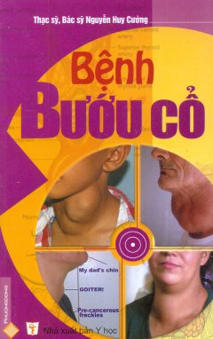 Bệnh Bướu Cổ